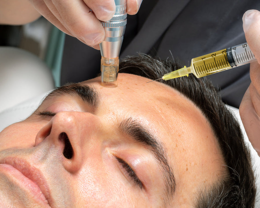 Mens Skin Needling