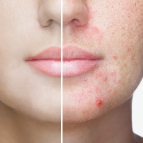 Problematic Skin Treatment (Acne Treatment)