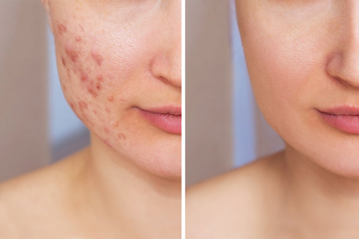 Problematic Skin Treatment (Acne Treatment)