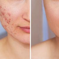 Problematic Skin Treatment (Acne Treatment)