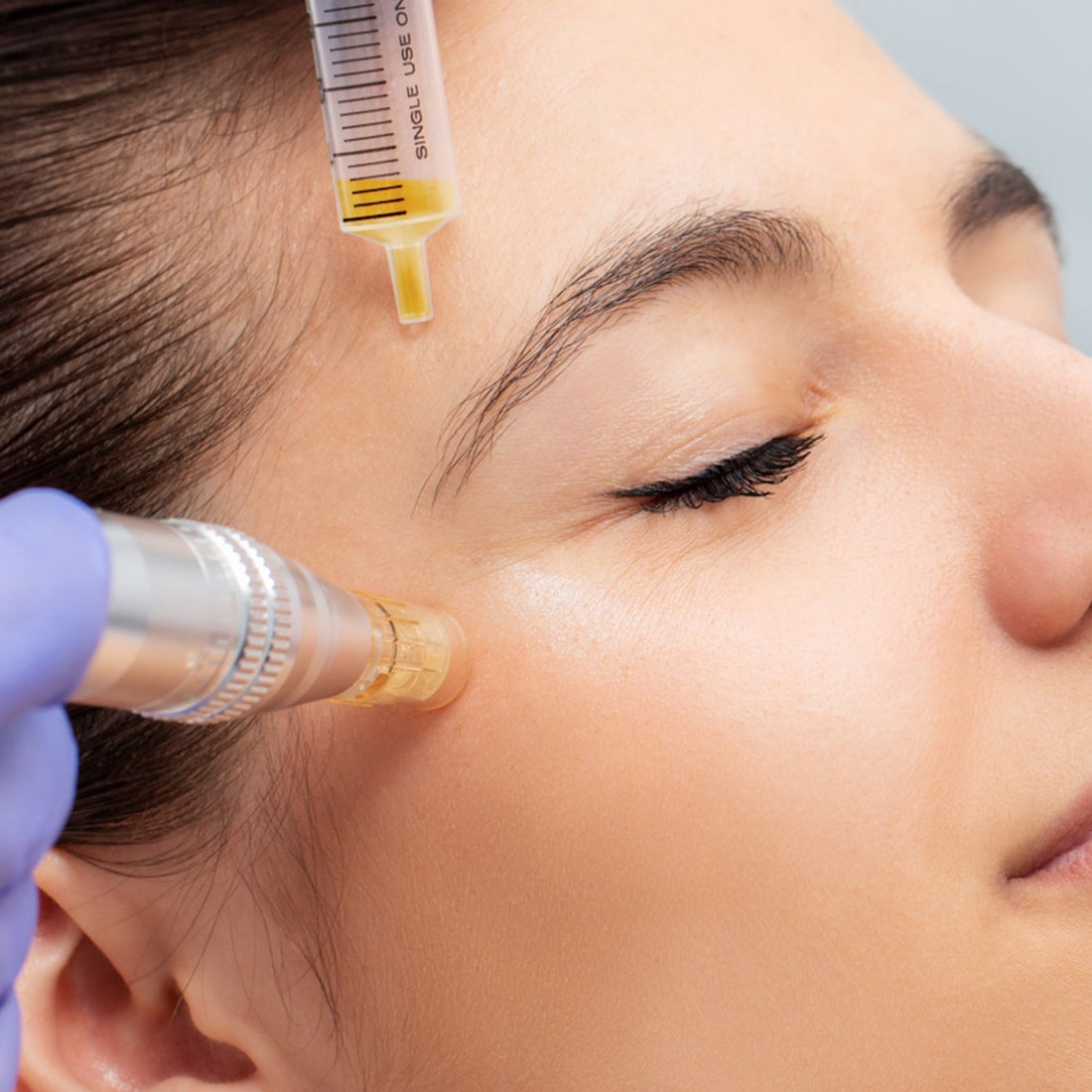 Skin needling treatment